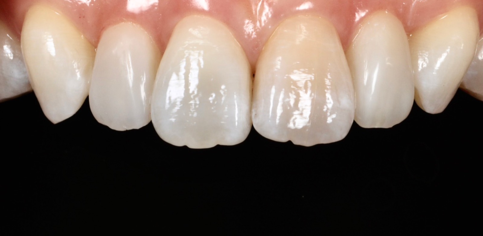 矮小歯・先天欠如歯 修復後